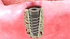 Implant for Crown and Bridge