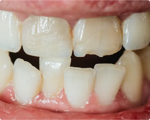 Close-up of misaligned and damaged teeth