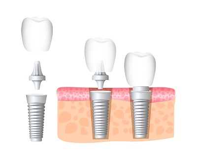 Dental implant: single titanium screw replacement tooth root