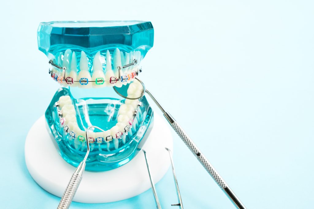 Dental model with braces, mirror, and tweezers for orthodontic treatment visualization.